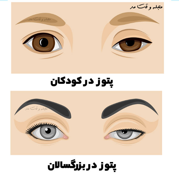 Drooping eyelid or ptosis in children and adults
