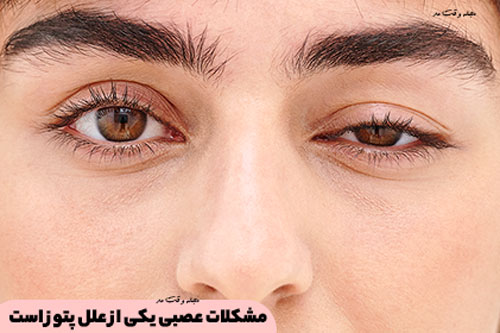 Neurological problems are one of the causes of ptosis or drooping eyelids