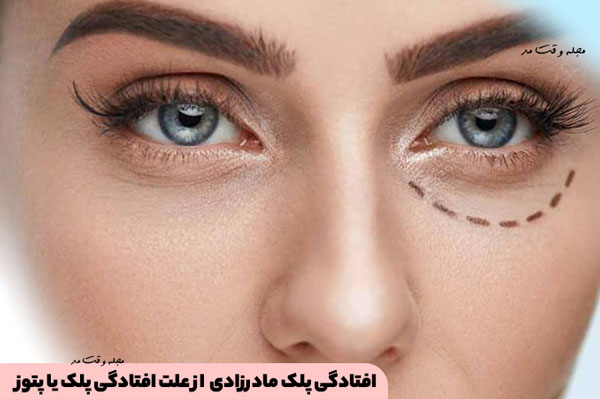 Congenital ptosis is one of the causes of ptosis