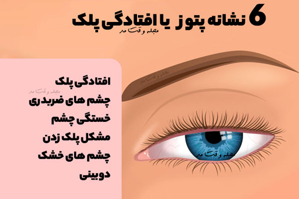 6 signs of eyelid droop or ptosis in this photo