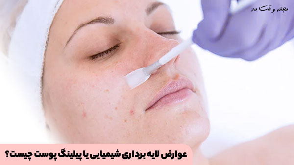 Side effects of chemical peeling or skin peeling