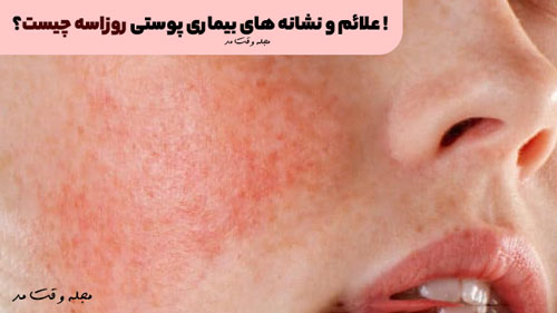 Signs and symptoms of rosacea skin disease 