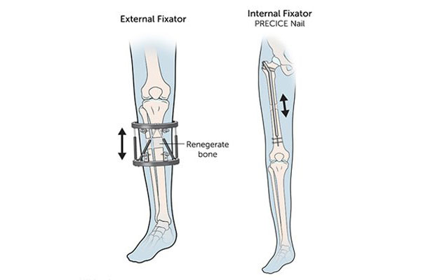 Height increase surgery