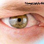 An example of eyelid drooping or ptosis