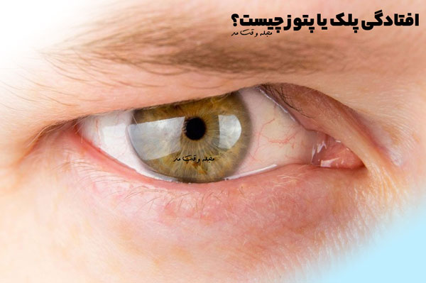 An example of eyelid drooping or ptosis