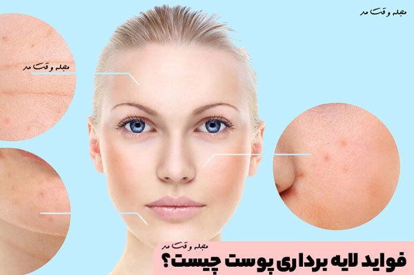 Creating new layers of skin is part of the benefits of skin peeling