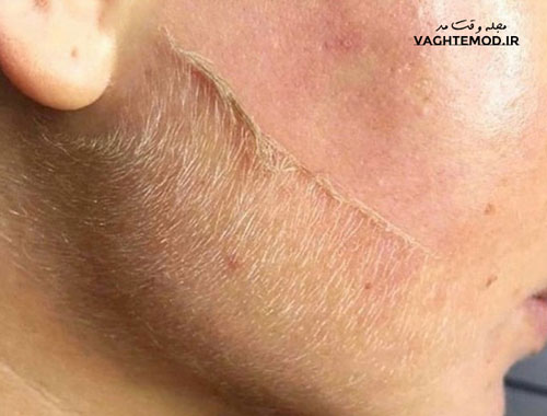 Before and after dermaplaning