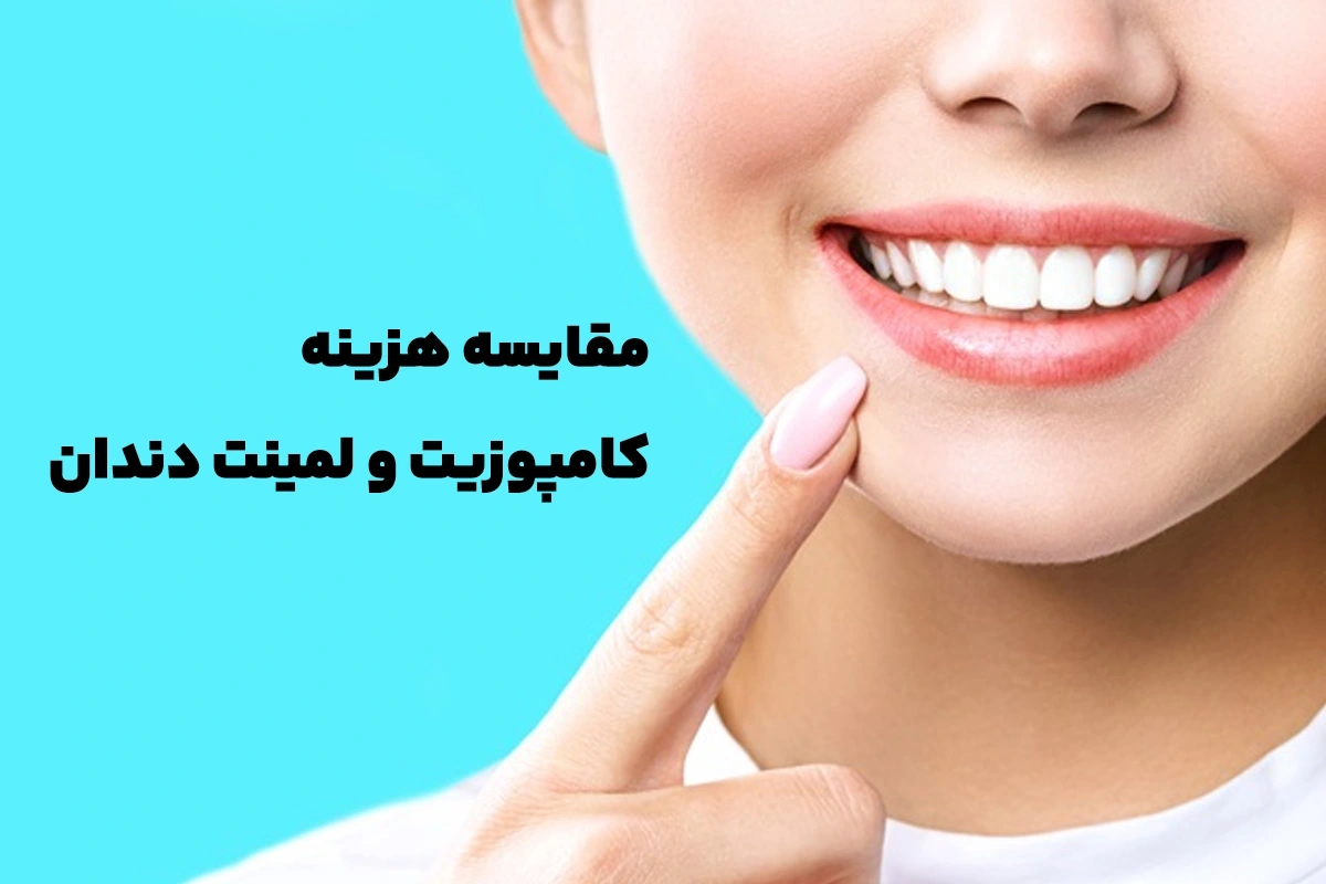 Comparing the cost of dental composite and laminate