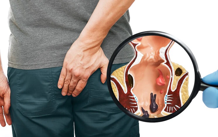 Home remedies for protruding hemorrhoids