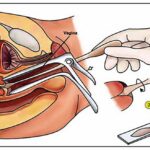 Pap Smear Test | Cervical Cancer Screening IVF Infertility Pap smear test