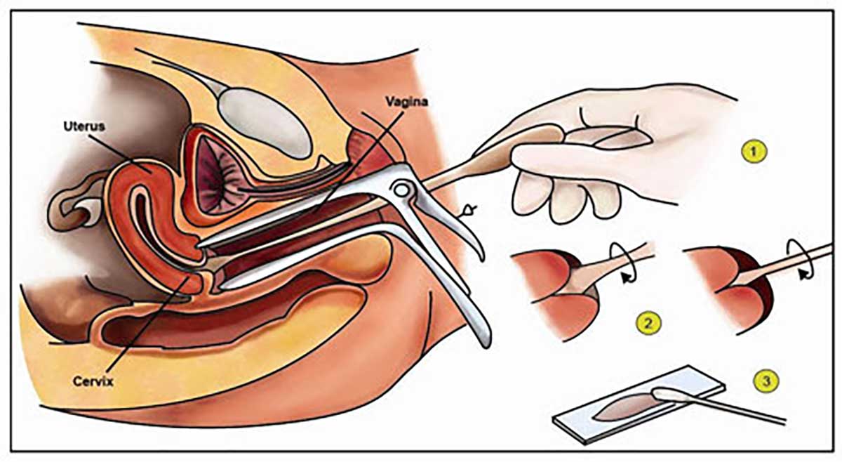 Pap Smear Test | Cervical Cancer Screening IVF Infertility Pap smear test