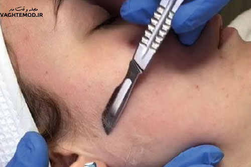 What is dermaplaning?