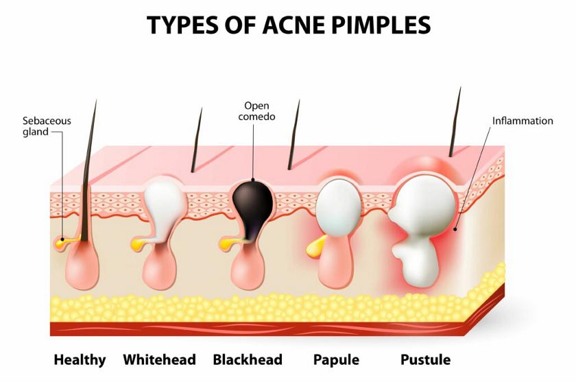The scieific reason for blackheads