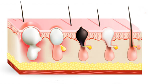 You can see the cause of facial acne in a picture.