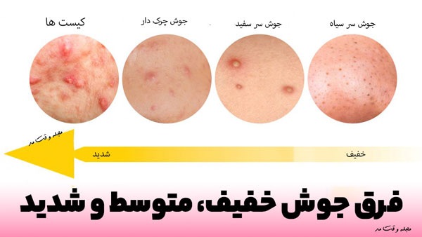You can see the difference between mild, moderate and severe boils.