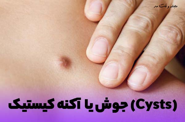A picture of a large cystic pimple that is painful
