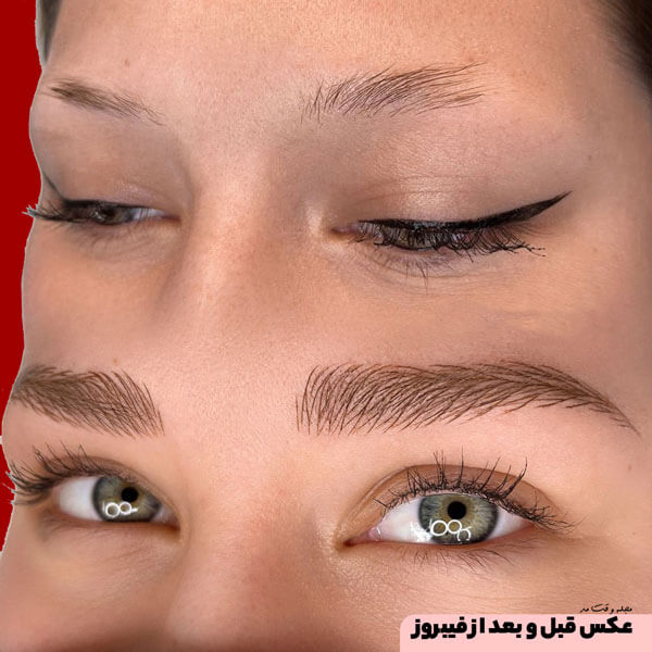 Photo before and after eyebrow fibrosis