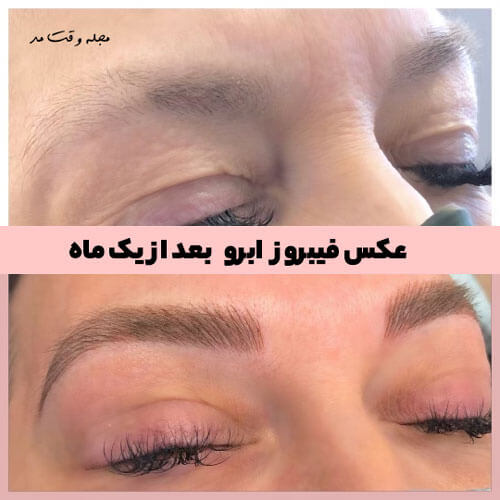 Photo of eyebrow fibrosis after one moh