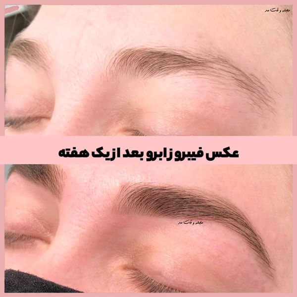 Photo of eyebrow fibrosis after a week