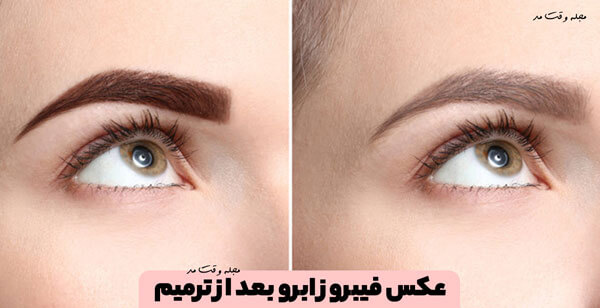 Photo of eyebrow fibrosis after repair