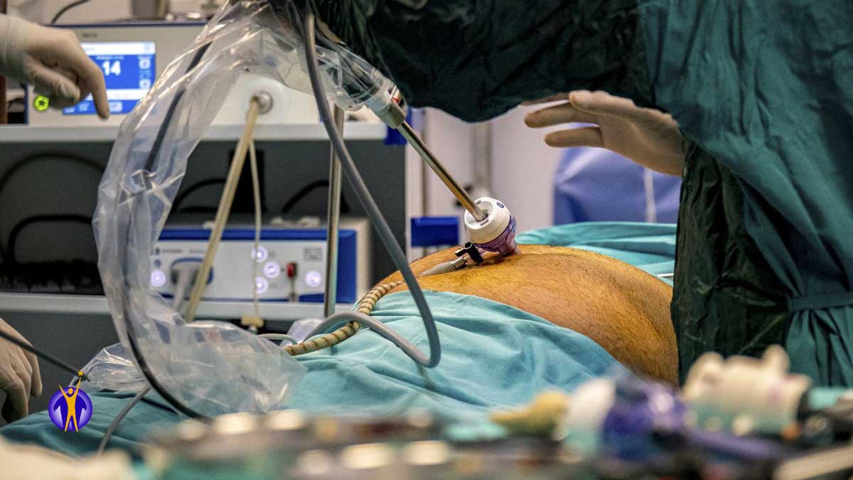 Gastric sleeve surgery