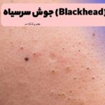 An example of facial blackheads