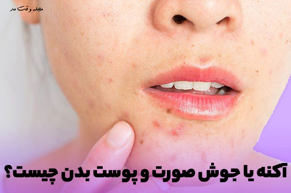 A picture of severe acne on the chin