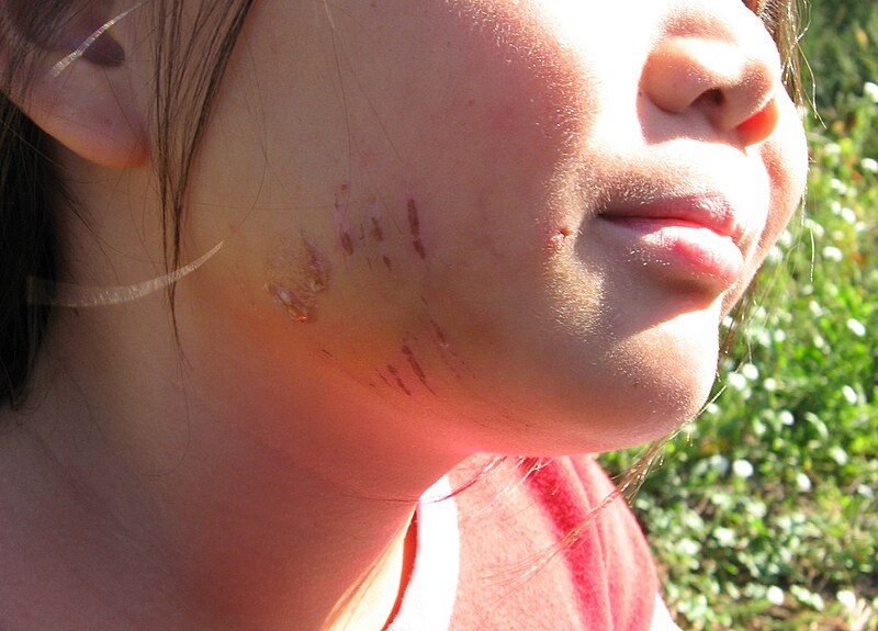 Effects of dog attack on human face. Source: Wikimedia website; Photographer: Tanner Ford, TRFPhotography