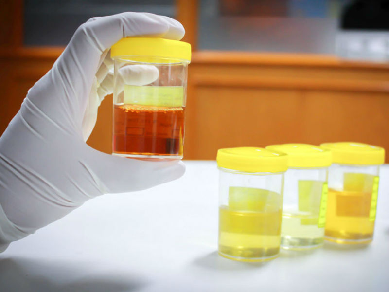Treatme of blood in men's urine