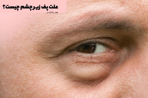Types of causes of puffiness under the eyes