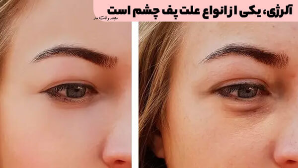 Allergy is one of the causes of puffy eyes