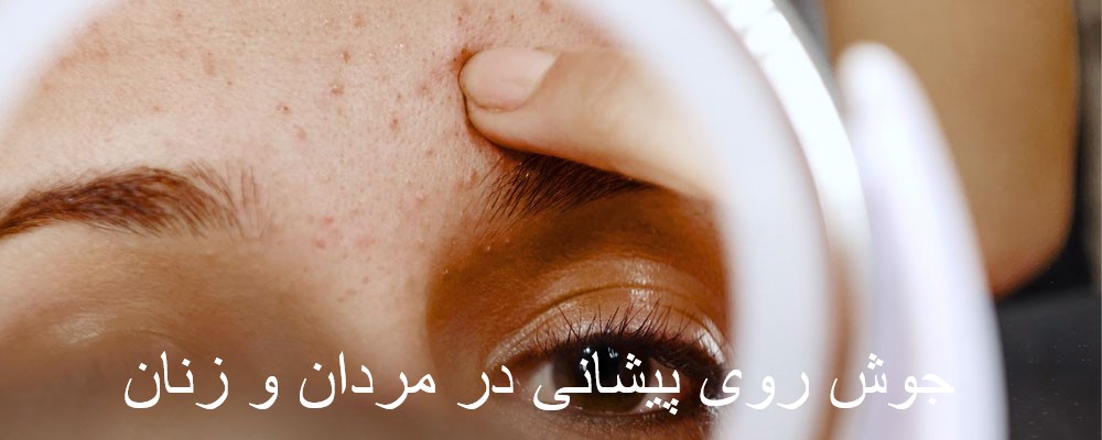 What is a pimple on the forehead?