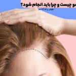 hair mesotherapy; It is a treatment method that is performed by injecting vitamins, minerals and a mixture of amino acids needed by the scalp.