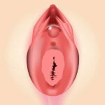 Hymen rupture repair