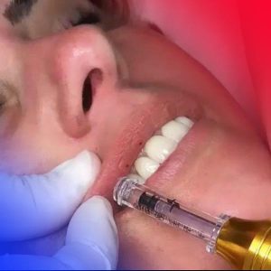 How to inject lip gel to plump up lips 