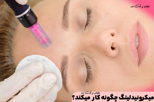 Microneedling increases collagen production by stimulating the skin