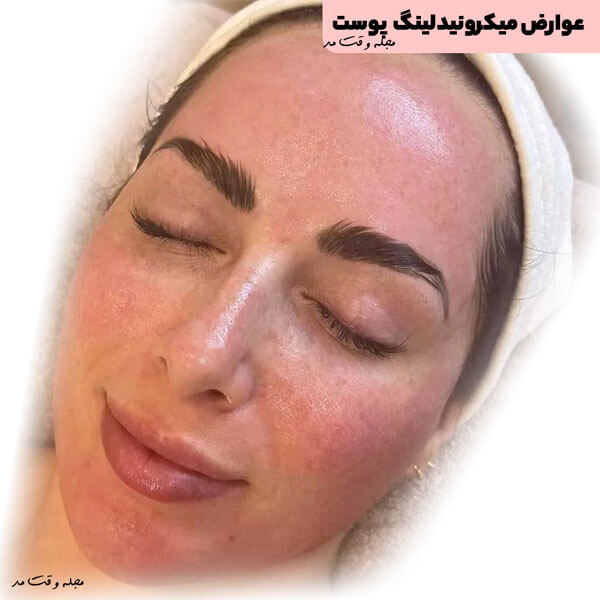 Side effects of skin microneedling