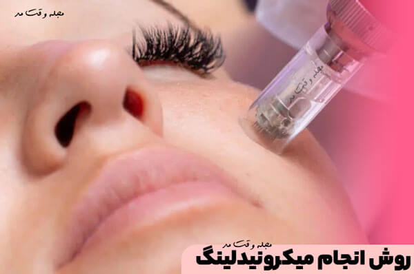 Microneedling method 