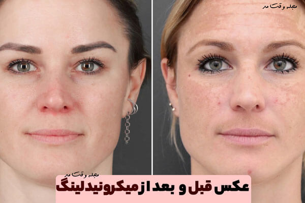 Photo before and after skin microneedling
