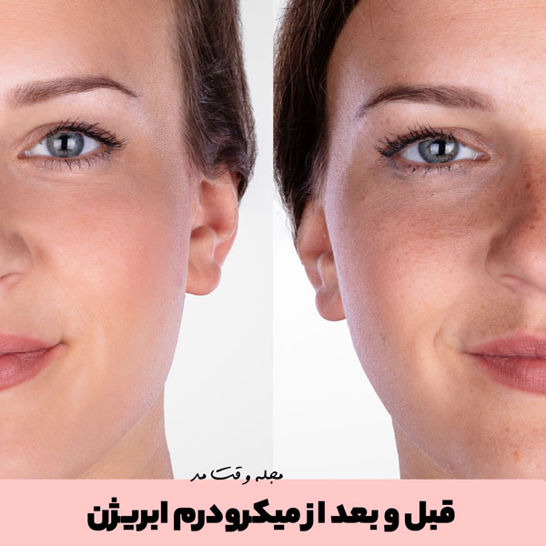 Photo before and after microdermabrasion