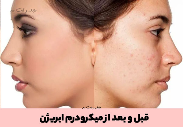 Photo before and after microderm