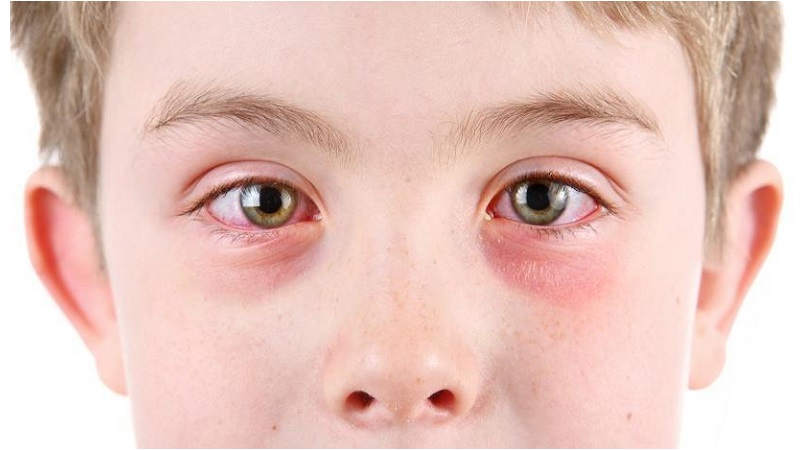 What is the cause of sudden red eyes in children?