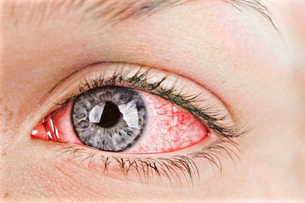 Treatme of sudden redness of the eyes
