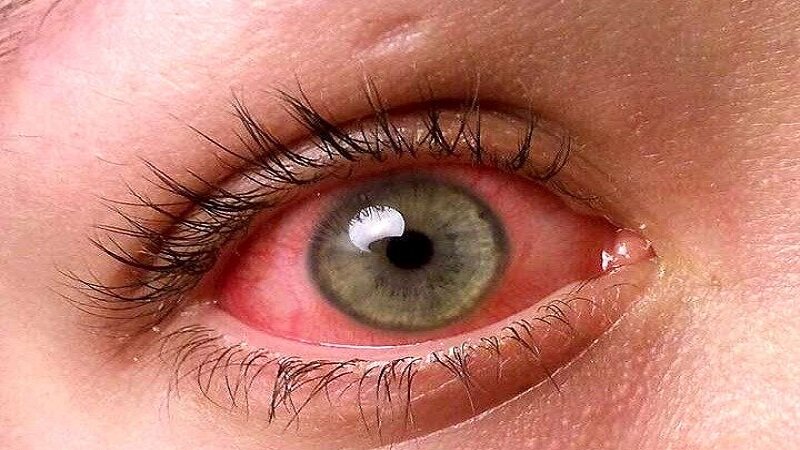 Causes of sudden red eyes in adults