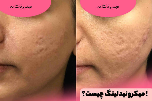What is microneedling?