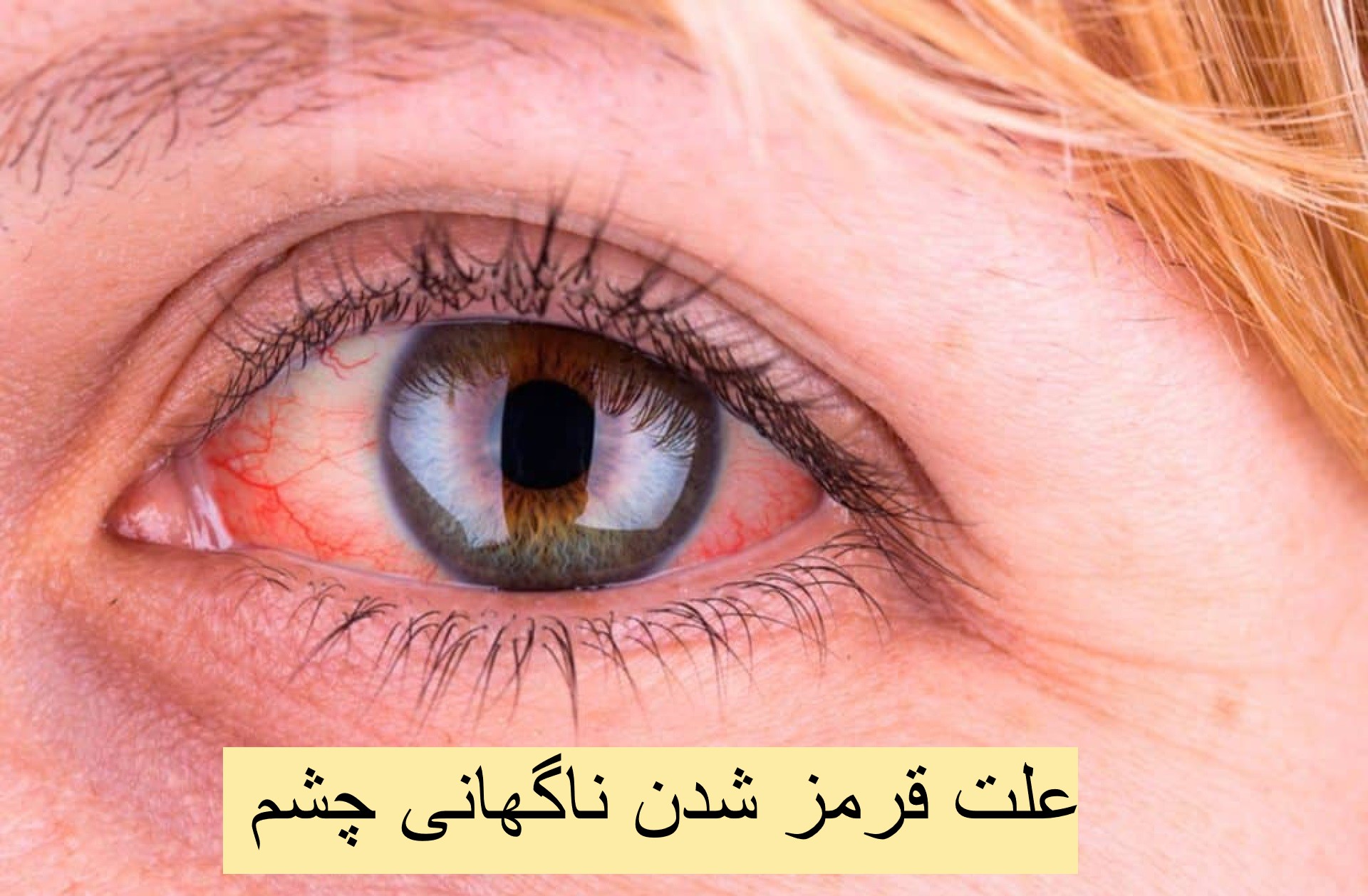 The cause of sudden red eyes