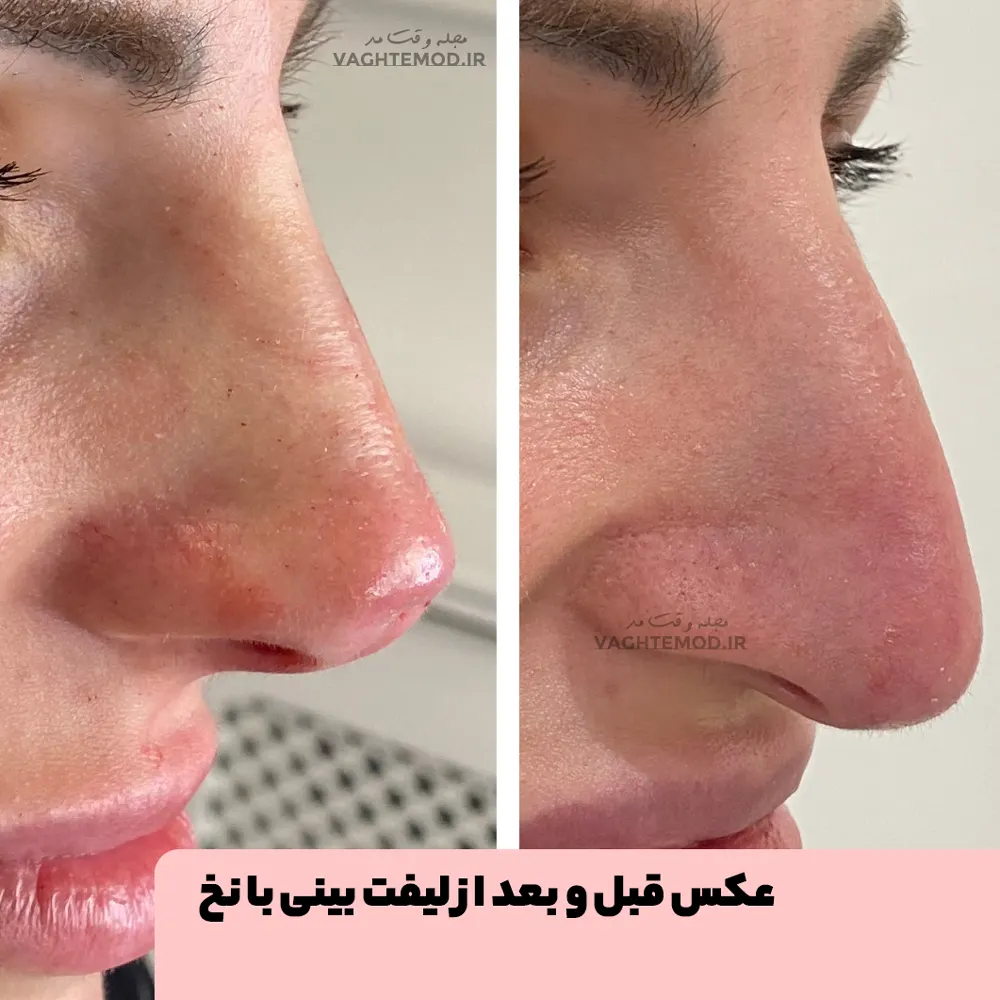 Photo before and after nose lift with thread