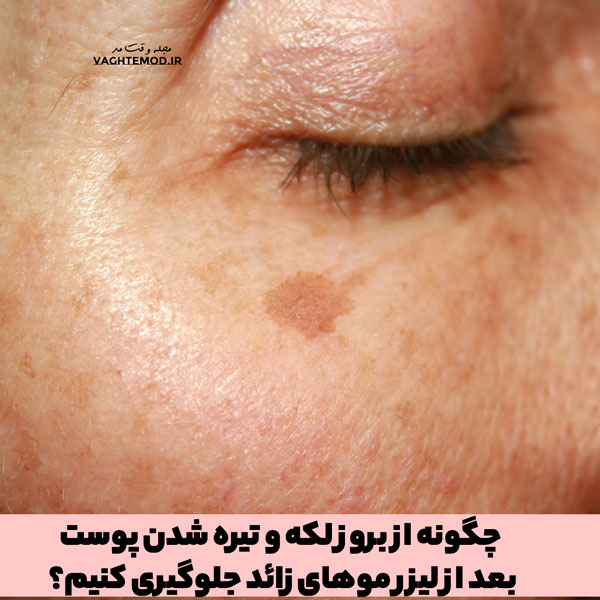 How to preve spots and skin darkening after laser hair removal?