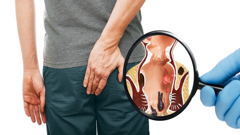 Immediate treatme of hemorrhoids at home