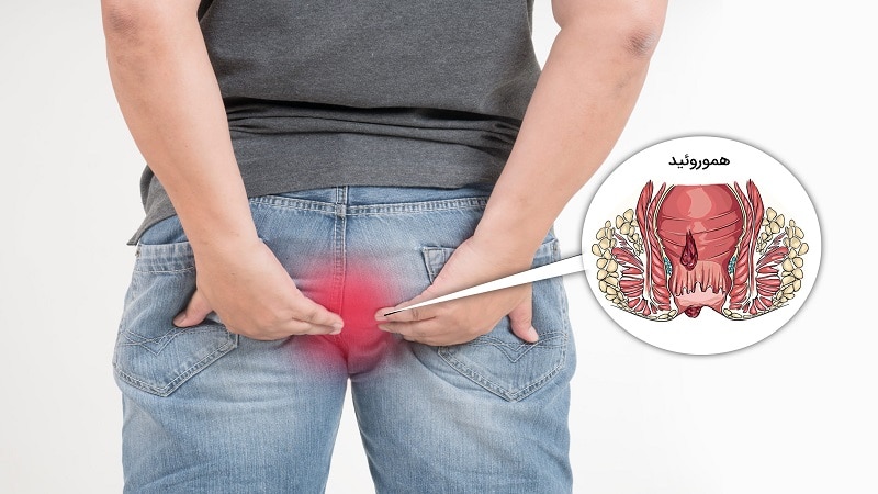 The best oime for hemorrhoids